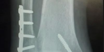 C.W. Stevens - Personal Injury Lawyer: Canton Car Accident & Injury Attorney